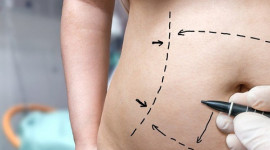 Phẫu thuật tạo hình thành bụng – 2 Tiếng để có vòng eo thực sự săn chắc, thon gọn
